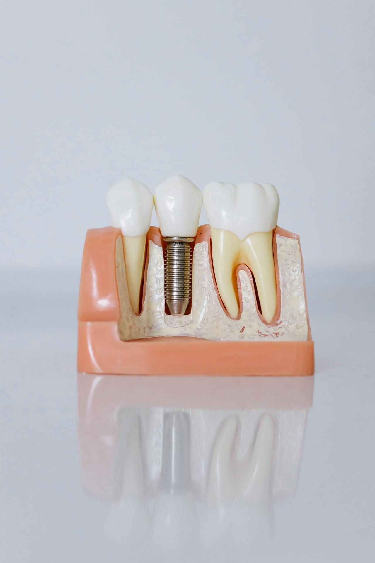 Resolving Dental Implant Complications